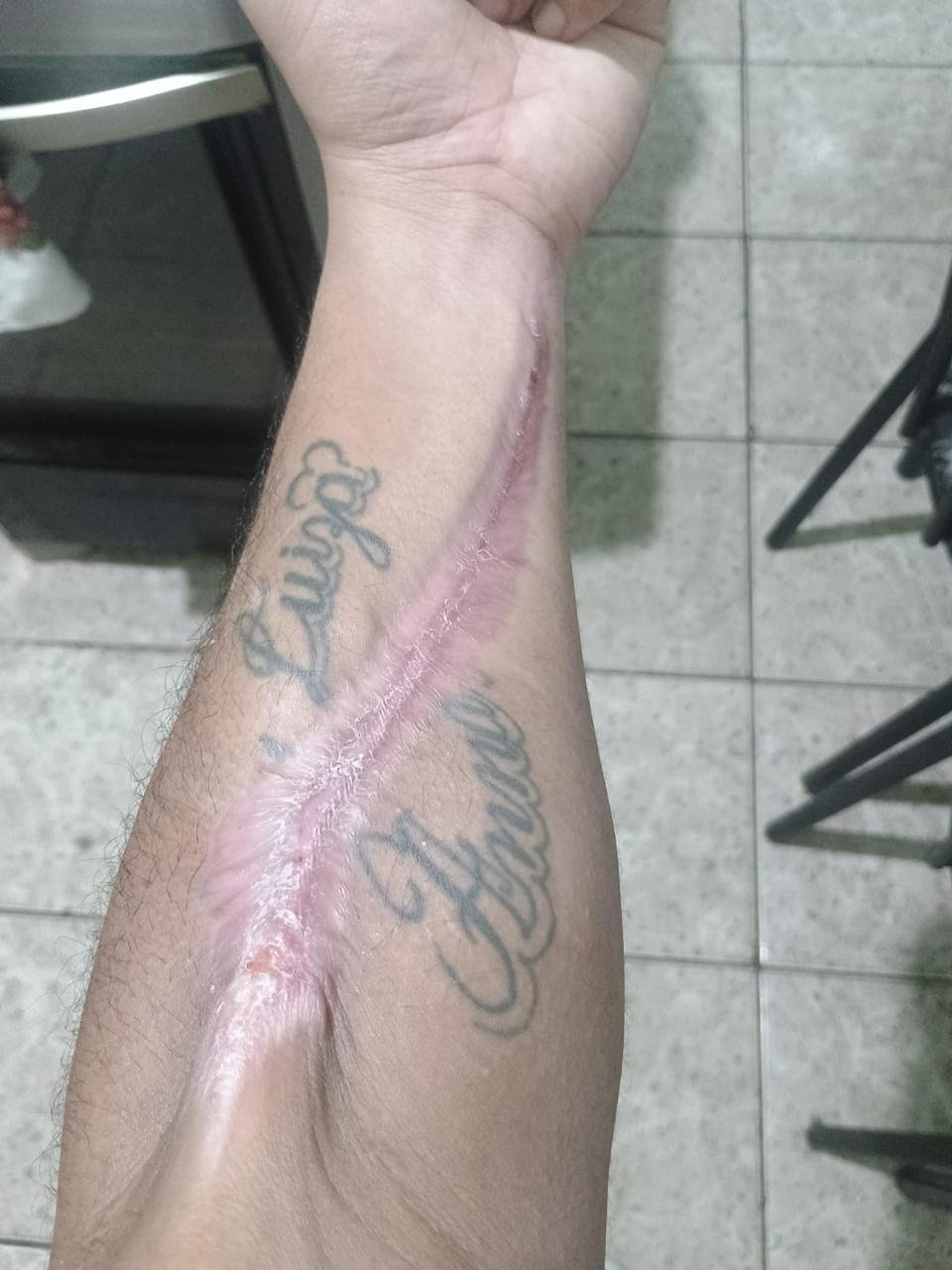 Lesão traumática — depois do tratamento
