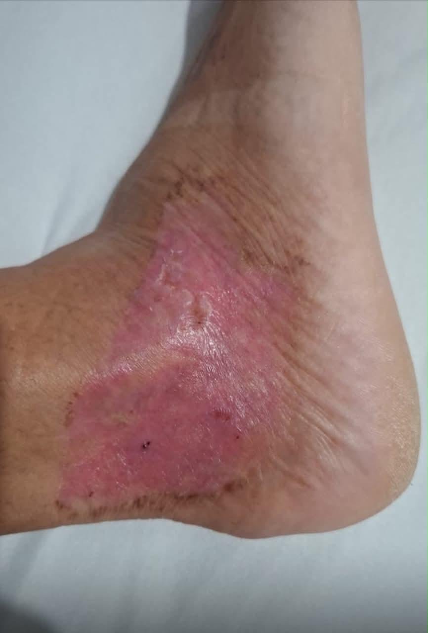 Queimadura — depois do tratamento