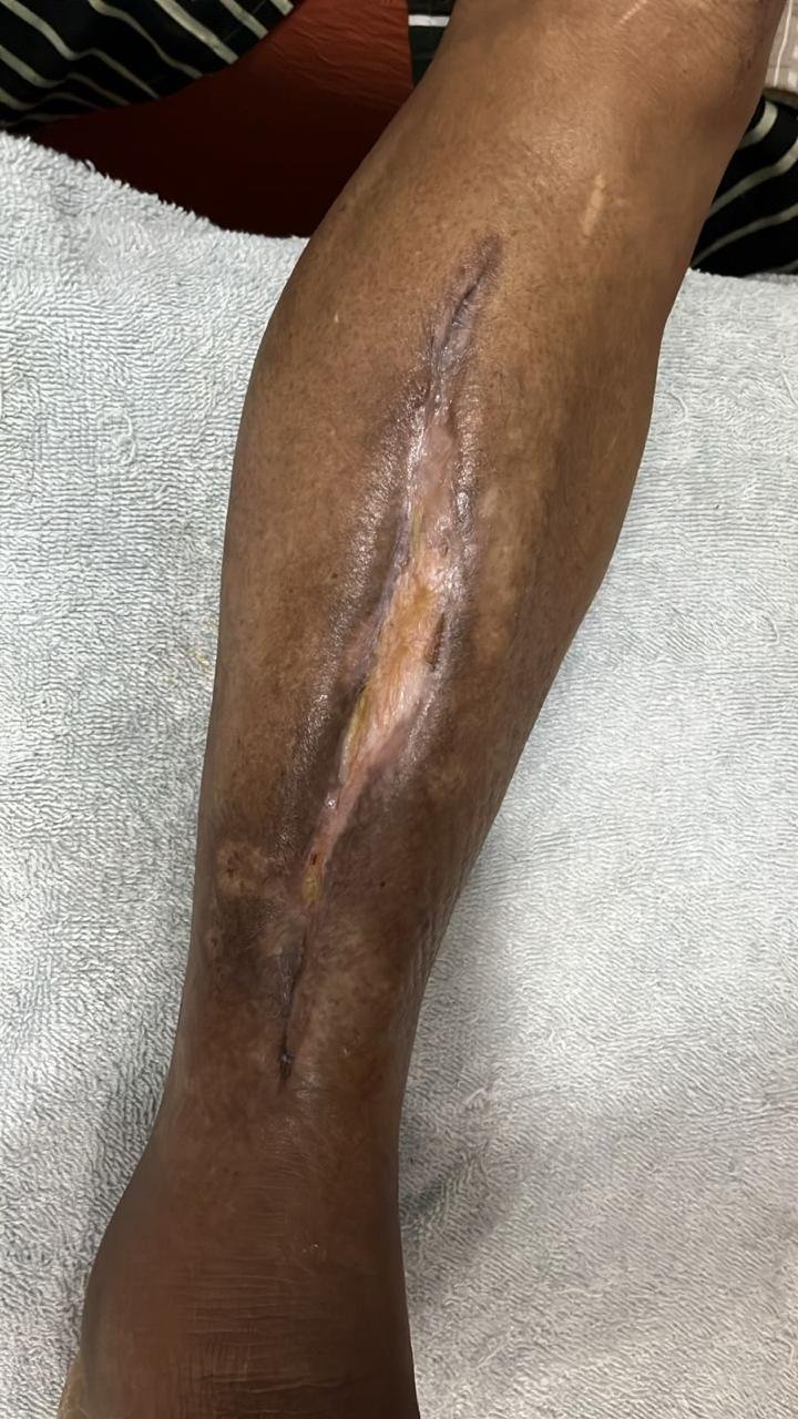 Lesão vasculogênica — depois do tratamento